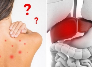Dấu Hiệu Mẩn Ngứa, Mụn Nhọt Có Thể Bạn Đã Mắc Bệnh Lý Về Gan